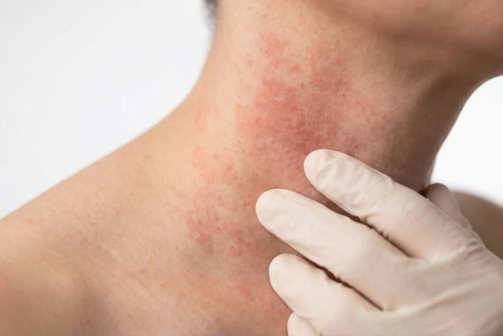 Dermatologist in Indirapuram for Skin Care - Le Crest Hospital